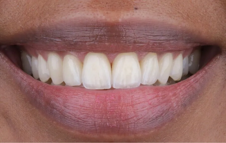 4-Veneers-After-900x570-1