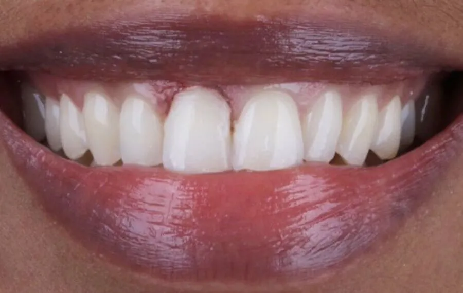 4-Veneers-Before-900x570-1
